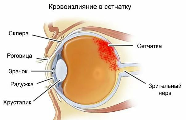 Внутреннее кровотечение у взрослых: симптомы, причины, лечение