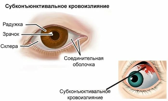 Субконъюнктивальное кровоизлияние глаза