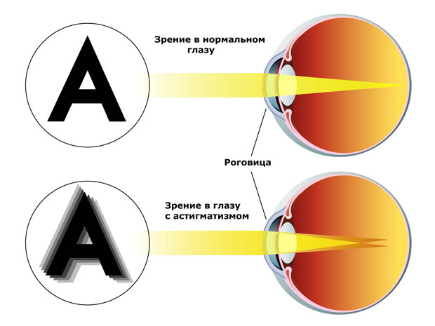 астигматизм схема