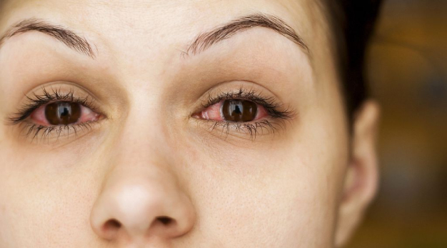 аллергия на глазах