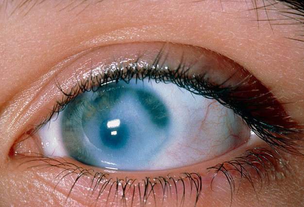 как выглядит глаукома