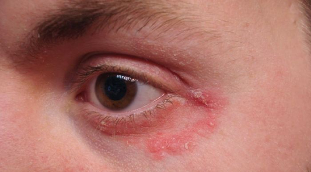 аллергия под глазами