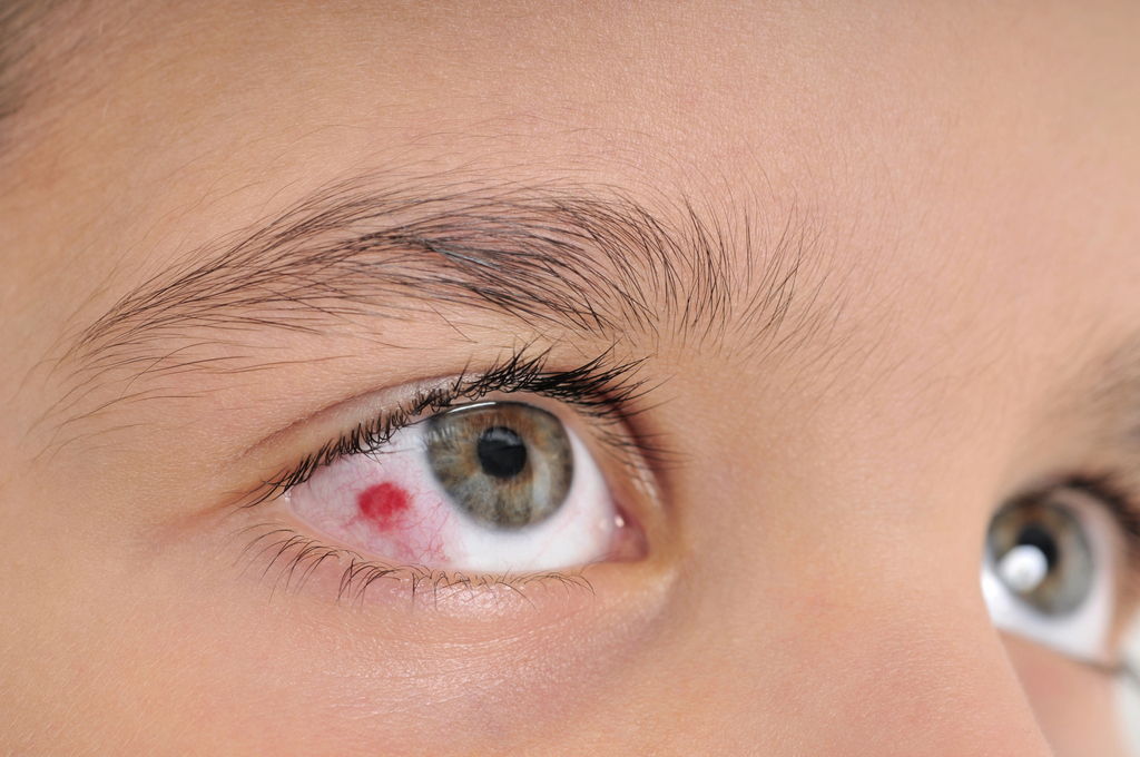 Кровоизлияние в глаз – причины и лечение красного пятна в глазу