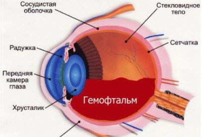 Кровоизлияние в глаз: причины, диагностика и методы лечения